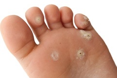 Hpv virus warts on feet. Specii mici de vierme